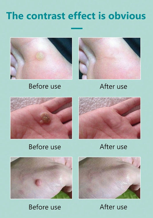 Plantar Wart Corn Remover