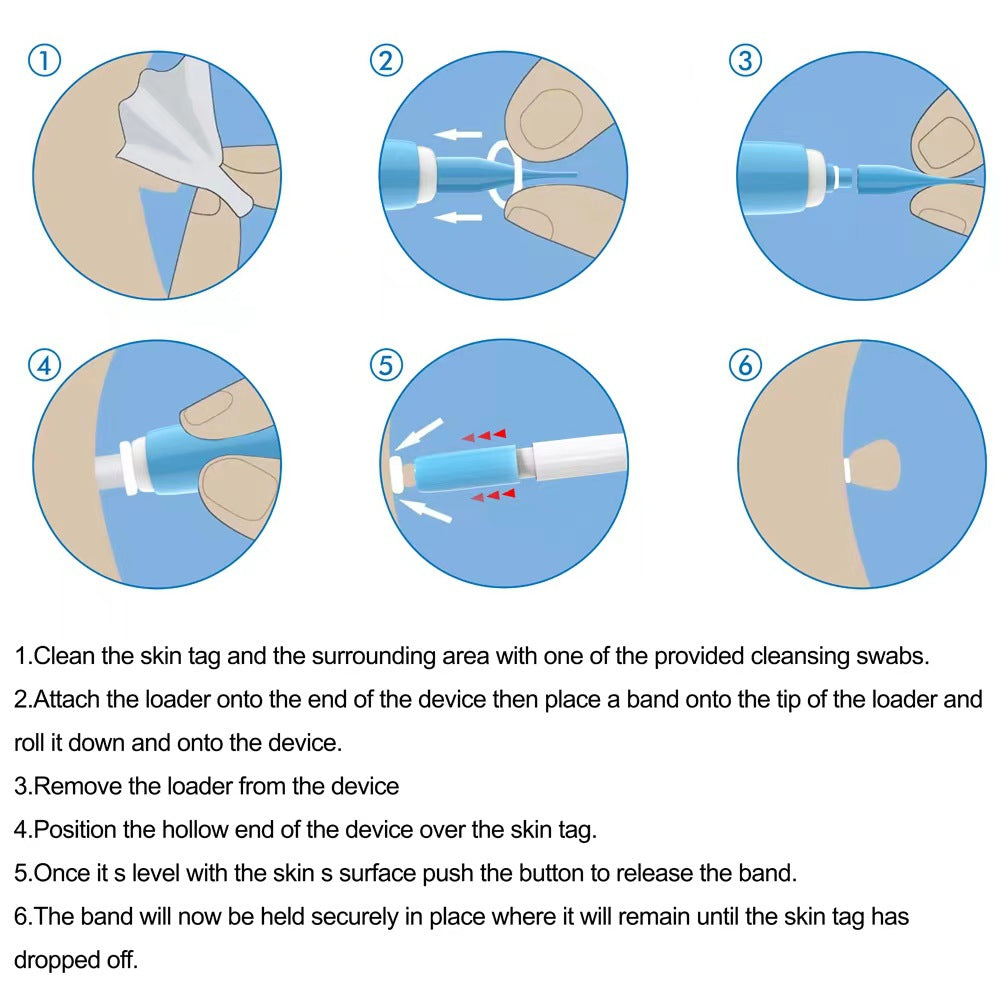 2-in-1 Skin Tag Removal Tool Skin Tag Falls Off Naturally